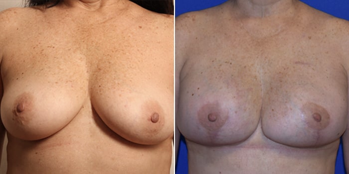 Patient 01 Front Side View Breast Reconstruction Breast Health Institute Houston