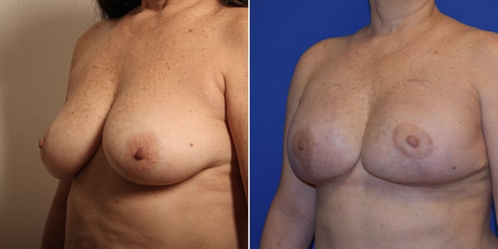 Patient 01 3/4th Left Side View Breast Reconstruction Breast Health Institute Houston