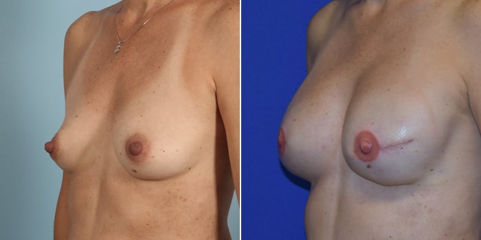Patient 03 3/4th Left Side View Breast Reconstruction Breast Health Institute Houston