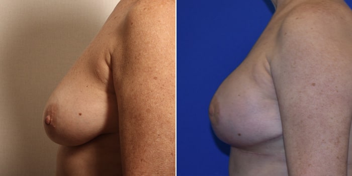 Patient 01 Left Side View Breast Reconstruction Breast Health Institute Houston