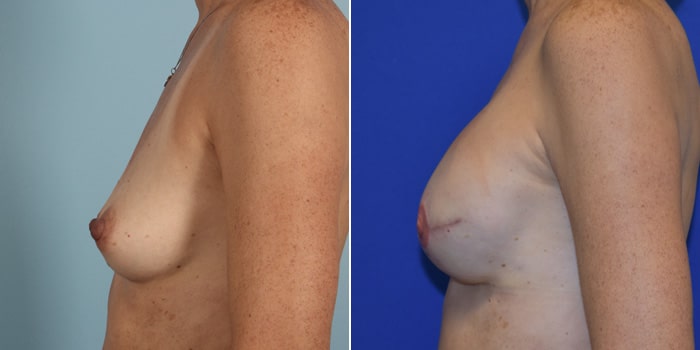 Patient 03 Left Side View Breast Reconstruction Breast Health Institute Houston