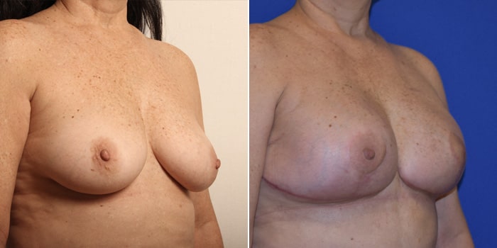 Patient 01 3/4th Right Side View Breast Reconstruction Breast Health Institute Houston