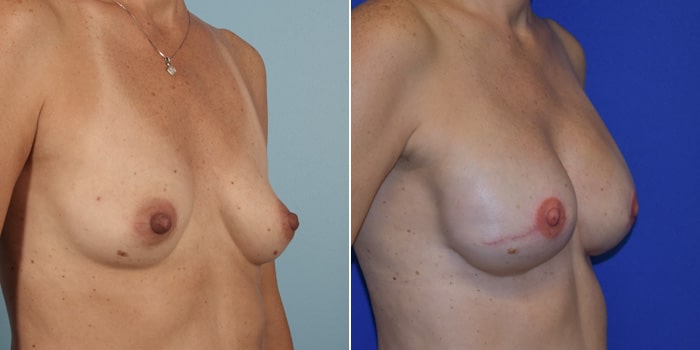Patient 03 3/4th Right Side View Breast Reconstruction Breast Health Institute Houston