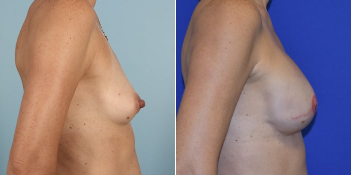 Patient 03 Right Side View Breast Reconstruction Breast Health Institute Houston