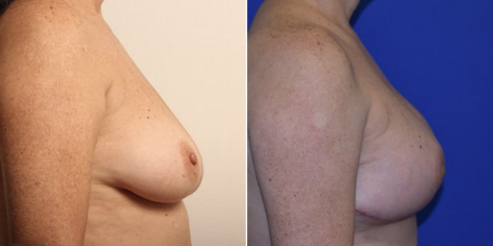 Patient 01 Right Side View Breast Reconstruction Breast Health Institute Houston