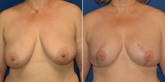 Patient 07 Front Side View Breast Reconstruction Breast Health Institute Houston