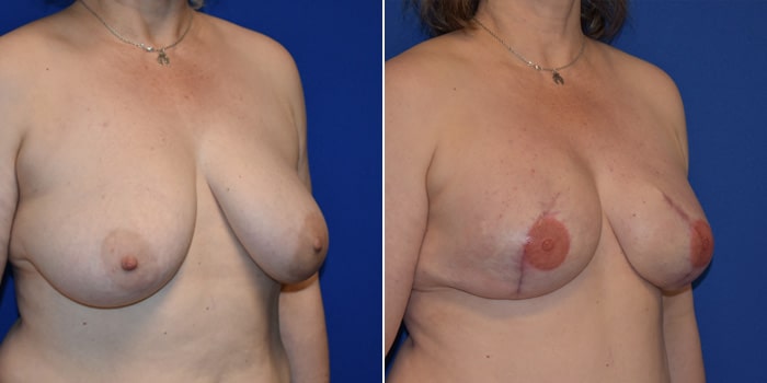 Patient 07 3/4th Right Side View Breast Reconstruction Breast Health Institute Houston