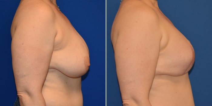 Patient 07 Right Side View Breast Reconstruction Breast Health Institute Houston