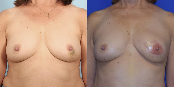 Patient 02 Front Side View Breast Reconstruction Breast Health Institute Houston