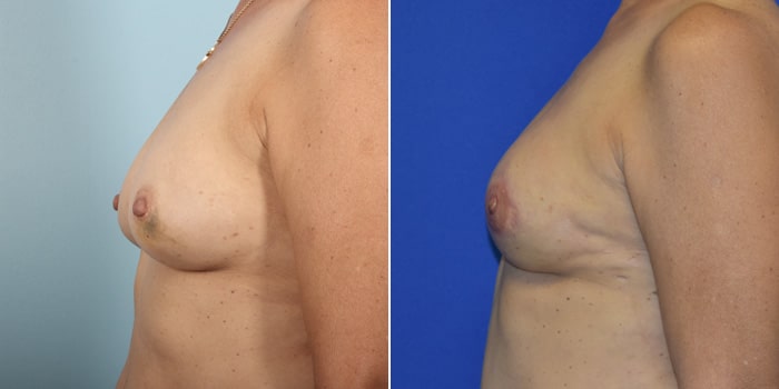 Patient 02 Left Side View Breast Reconstruction Breast Health Institute Houston