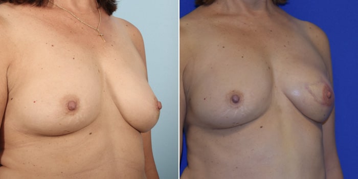 Patient 02 3/4th Right Side View Breast Reconstruction Breast Health Institute Houston