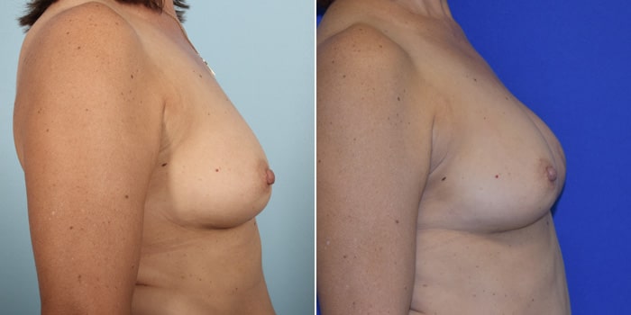Patient 02 Right Side View Breast Reconstruction Breast Health Institute Houston