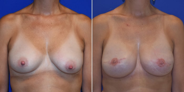 Patient 04 Front Side View Breast Reconstruction Breast Health Institute Houston