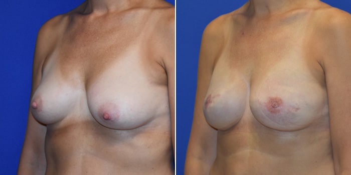 Patient 04 3/4th Left Side View Breast Reconstruction Breast Health Institute Houston