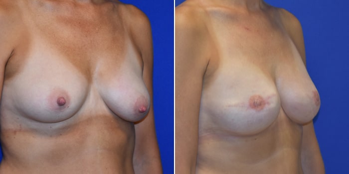Patient 04 3/4th Right Side View Breast Reconstruction Breast Health Institute Houston