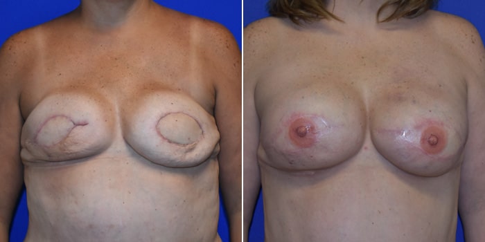 Patient 05 Front Side View Breast Reconstruction Breast Health Institute Houston