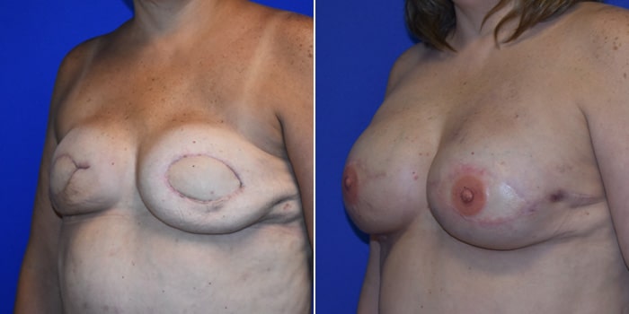Patient 05 3/4th Left Side View Breast Reconstruction Breast Health Institute Houston