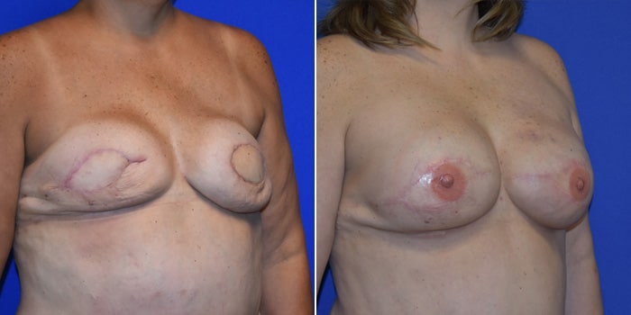 Patient 05 3/4th Right Side View Breast Reconstruction Breast Health Institute Houston