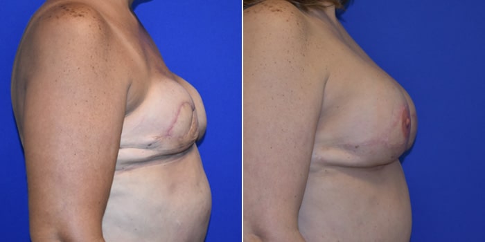 Patient 05 Right Side View Breast Reconstruction Breast Health Institute Houston