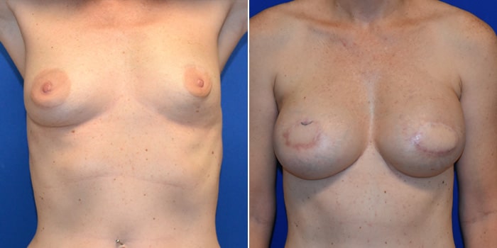 Patient 06 Front Side View Breast Reconstruction Breast Health Institute Houston
