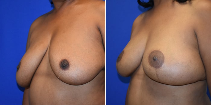 Patient 08 3/4th Left Side View Breast Reconstruction Breast Health Institute Houston