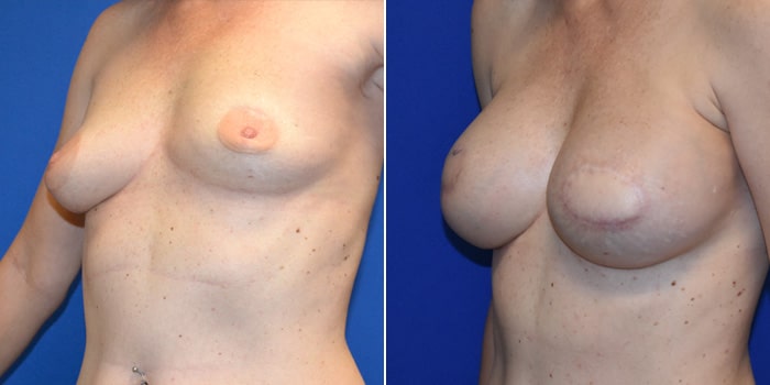 Patient 06 3/4th Left Side View Breast Reconstruction Breast Health Institute Houston