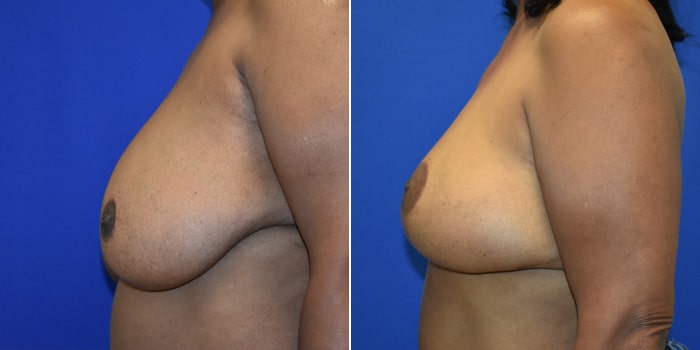 Patient 08 Left Side View Breast Reconstruction Breast Health Institute Houston
