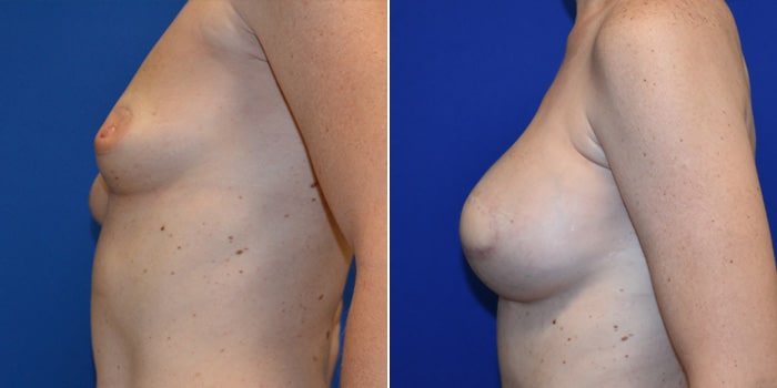 Patient 06 Left Side View Breast Reconstruction Breast Health Institute Houston