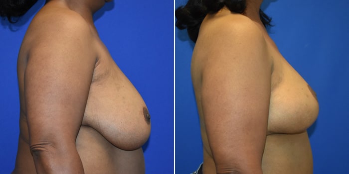 Patient 08 Right Side View Breast Reconstruction Breast Health Institute Houston
