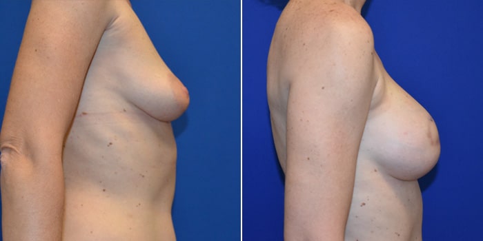 Patient 06 Right Side View Breast Reconstruction Breast Health Institute Houston