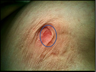 Full thickness biopsy of the right nipple