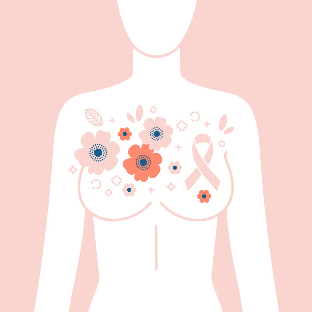 Options after mastectomy.